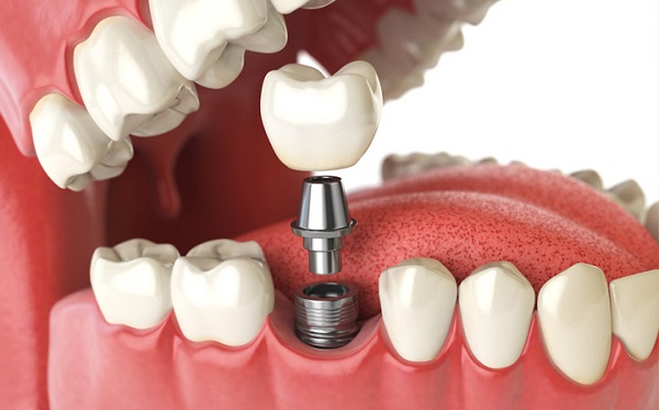 cấy ghép implant có đau không