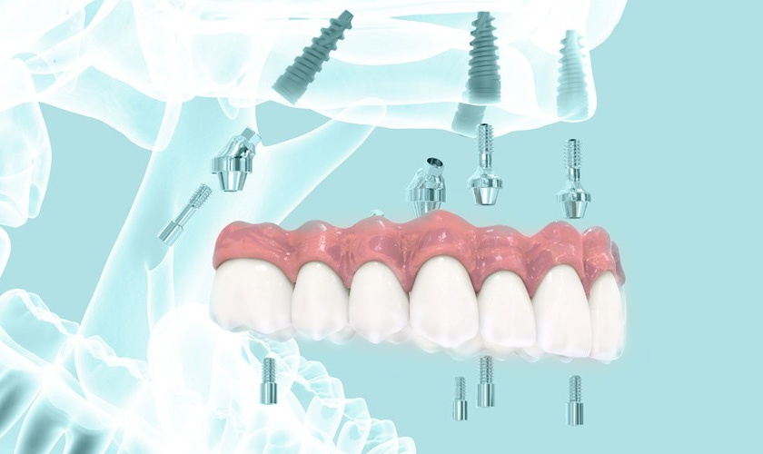 Phẫu thuật cấy ghép implant có đau không? Làm thế nào để giảm đau hiệu quả?